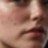 Close-up of skin affected by acne