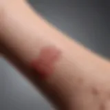 Close-up of eczema rash on wrist showing redness and irritation